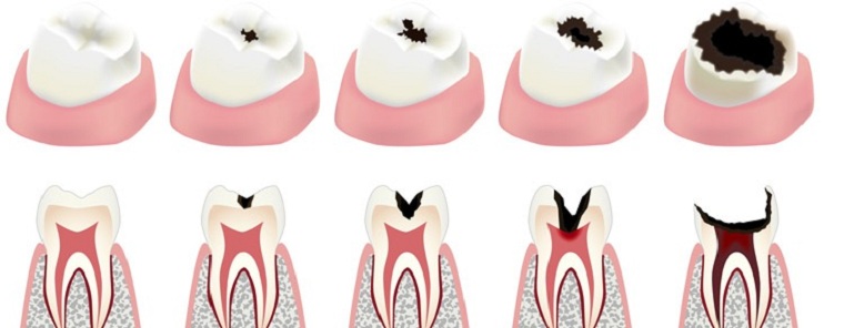 Как укрепить зубы, если они разрушаются