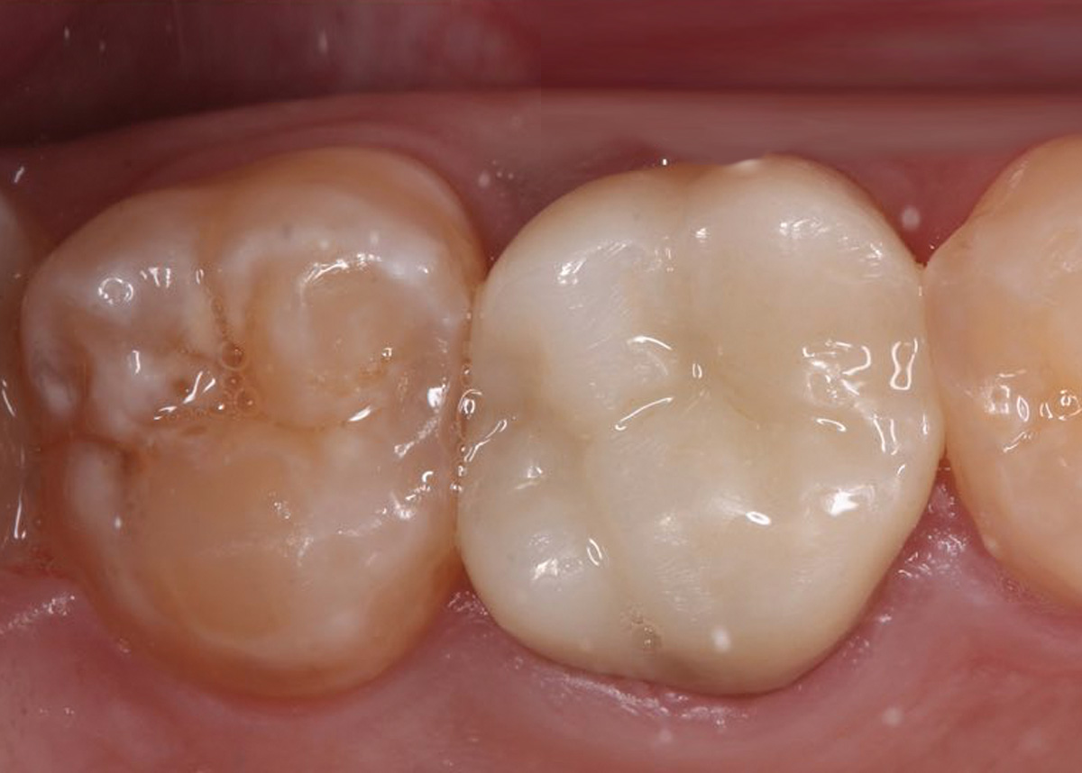 Восстановление зубов коронками