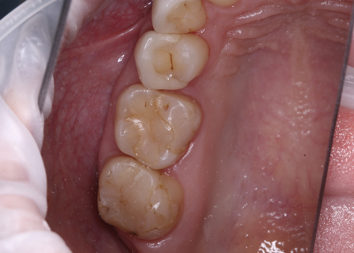 Восстановление зубов керамической коронкой Emax