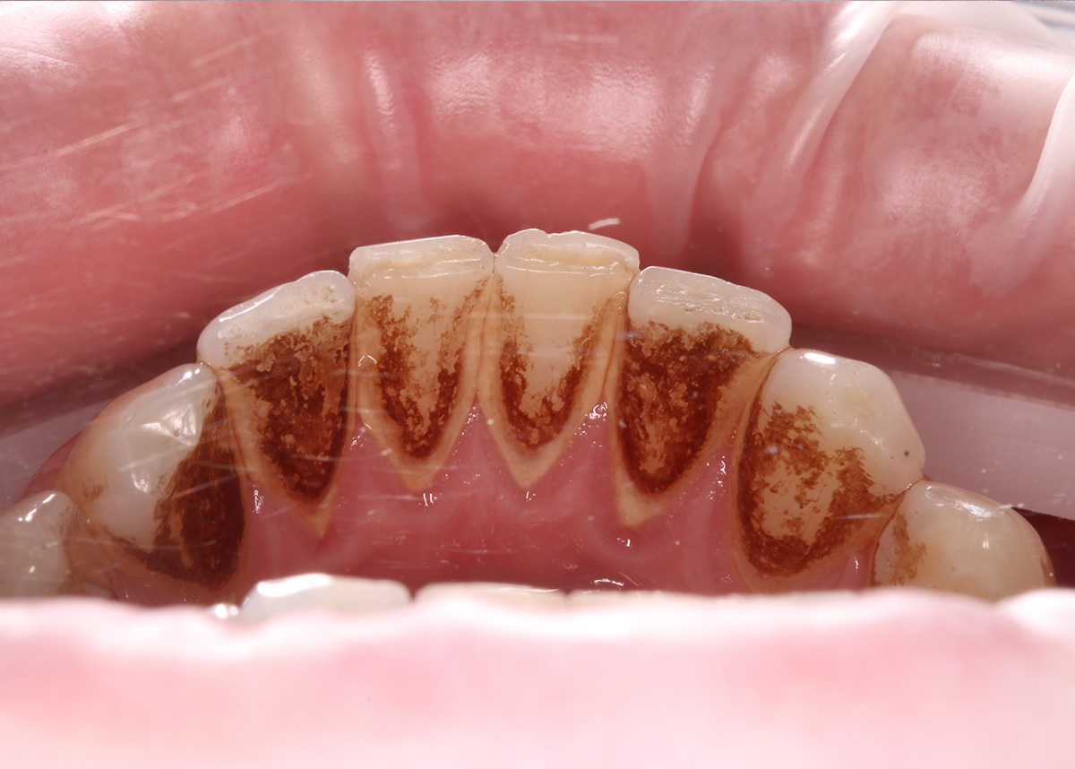 Профессиональная гигиена полости рта. Снятие наддесневых зубных отложений: пигментированного налета и зубного камня