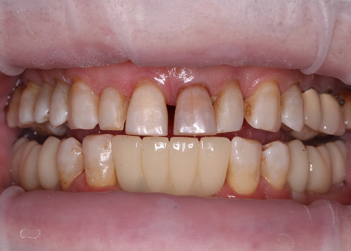Проведена большая работа по восстановлению целостности зубного ряда на нижней челюсти