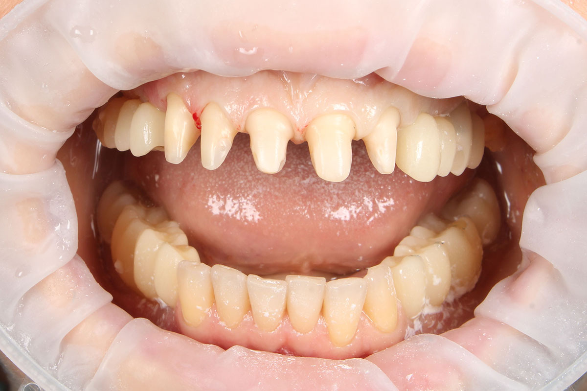 Восстановление эстетики зубов