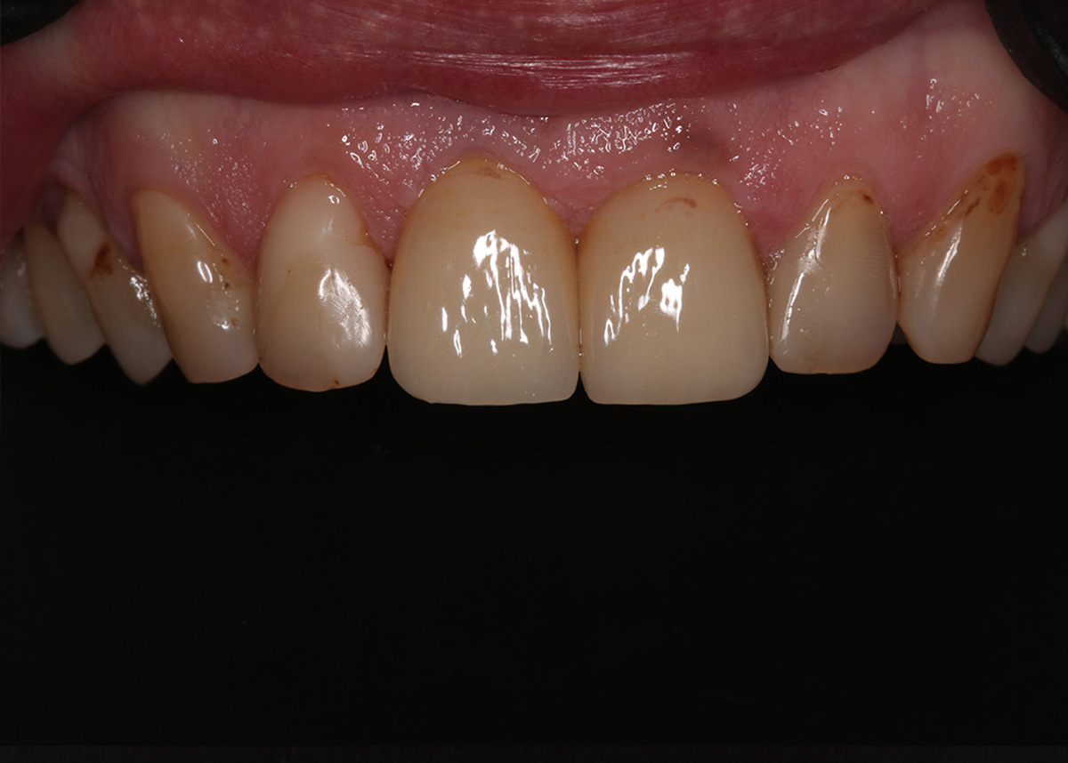 Эстетика центральных зубов и окончательное протезирование имплантата в области отсутствующего зуба