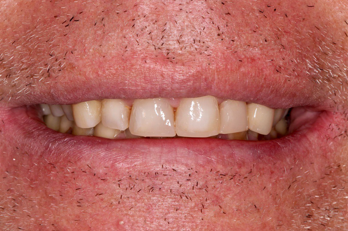 Восстановление функций и эстетики зубов