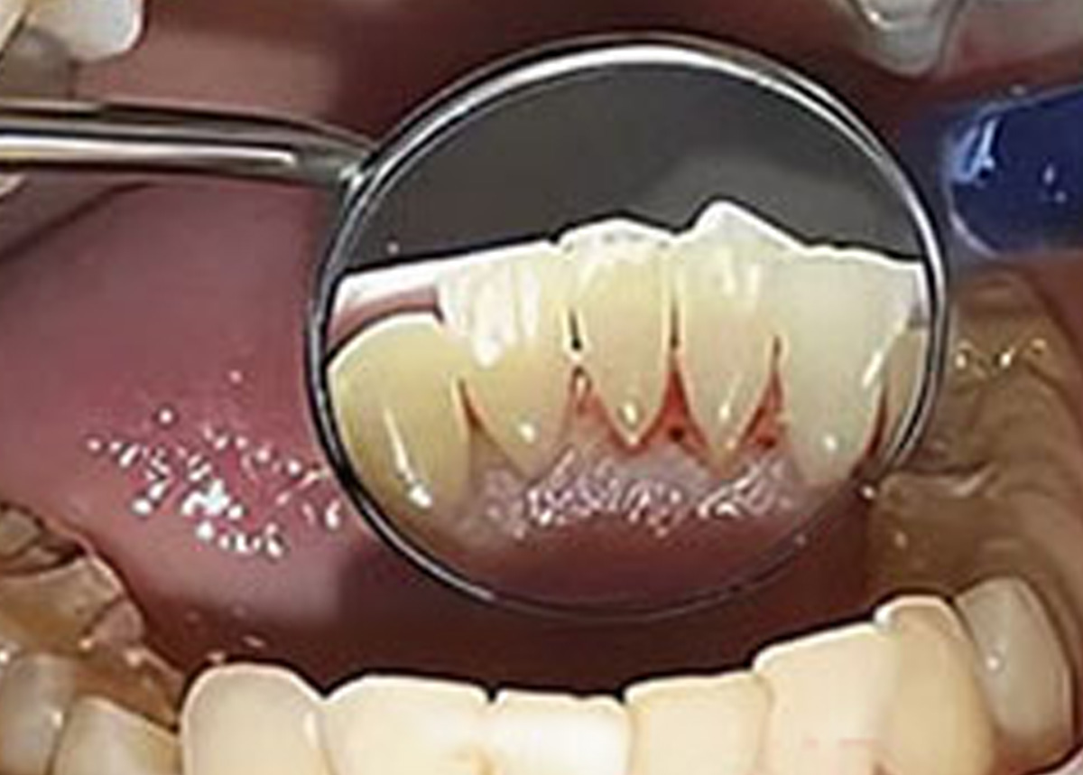 Профессиональная гигиена полости рта и зубов