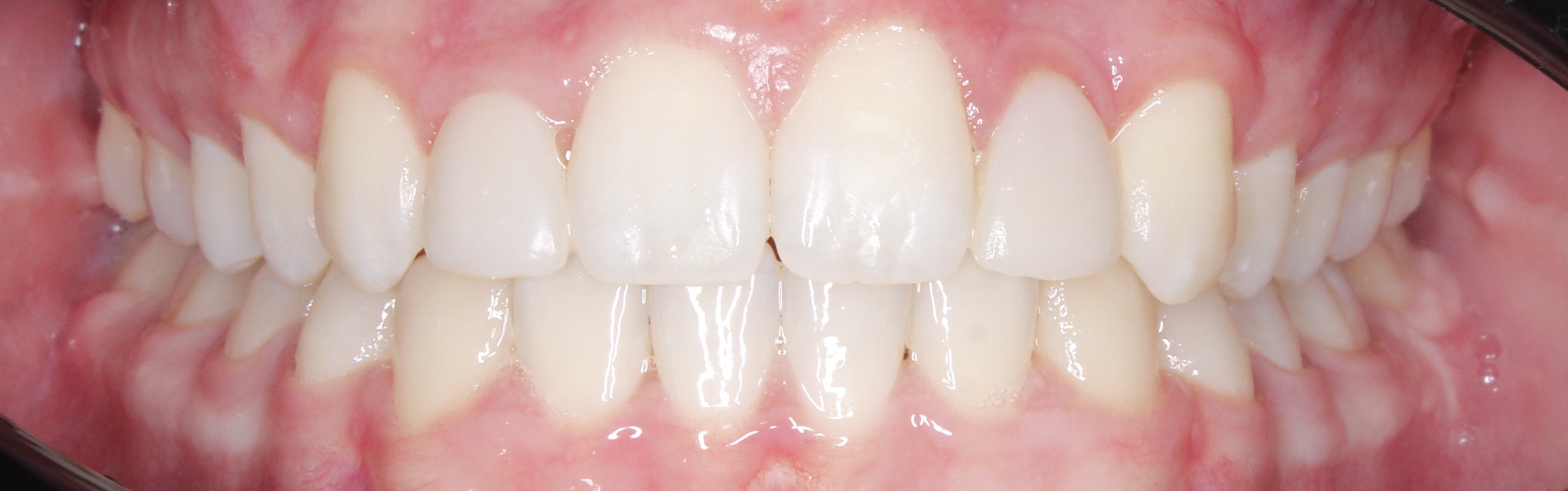 Коррекция смыкания, коррекция канта и реставрации боковых зубов после ортодонтического лечения.