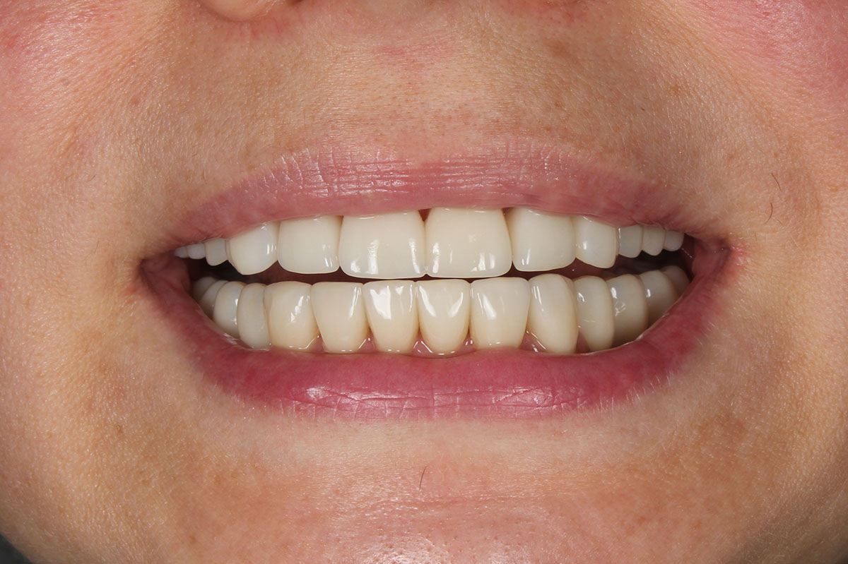 Восстановление эстетики зубов