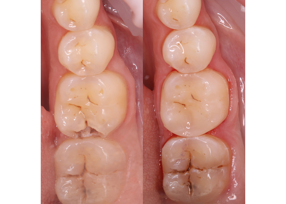 Восстановление зуба пациента пломбой 