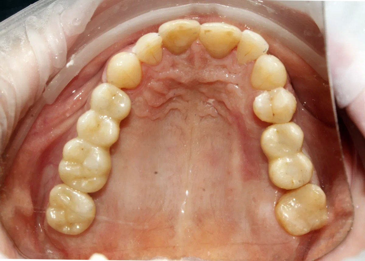 Пациентка обратилась с жалобами на отсутствие зубов 2.4, 2.5, 2.6, 2.7