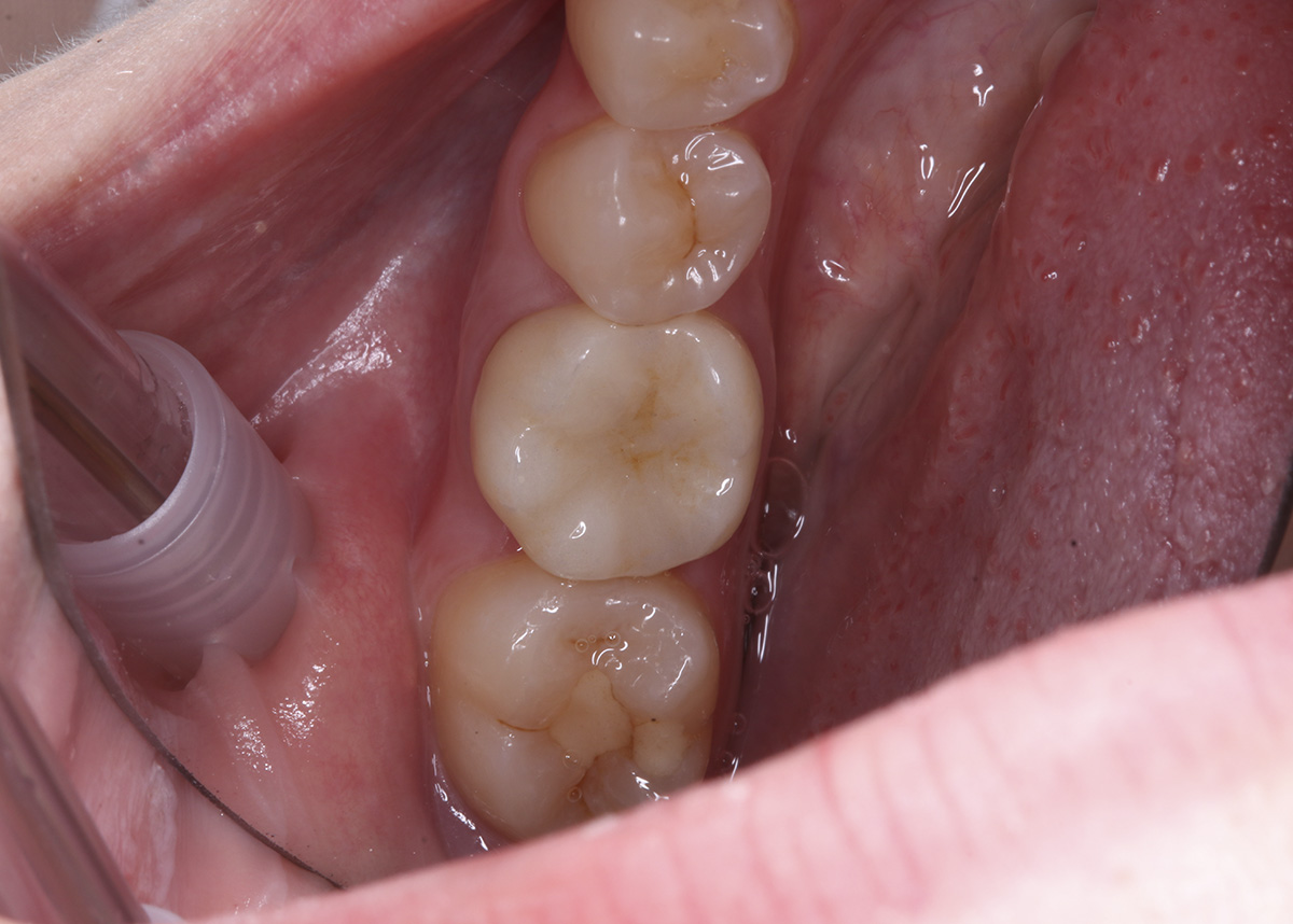 Восстановление зуба диоксидциркониевой коронкой