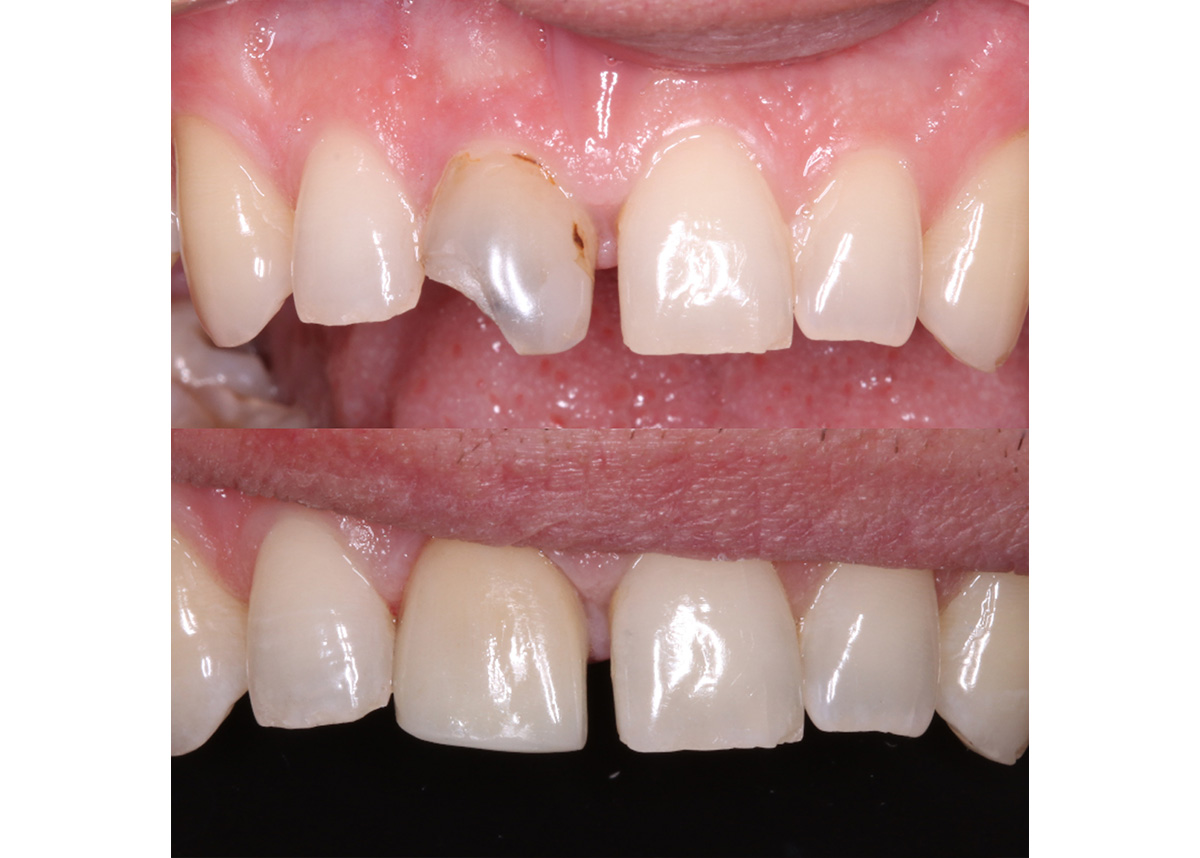 Восстановление разрушенного зуба в зоне улыбки керамической коронкой Emax