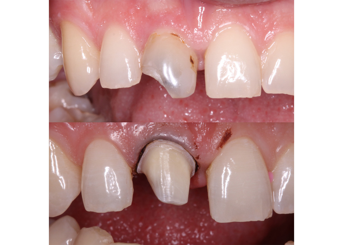 Восстановление разрушенного зуба в зоне улыбки керамической коронкой Emax