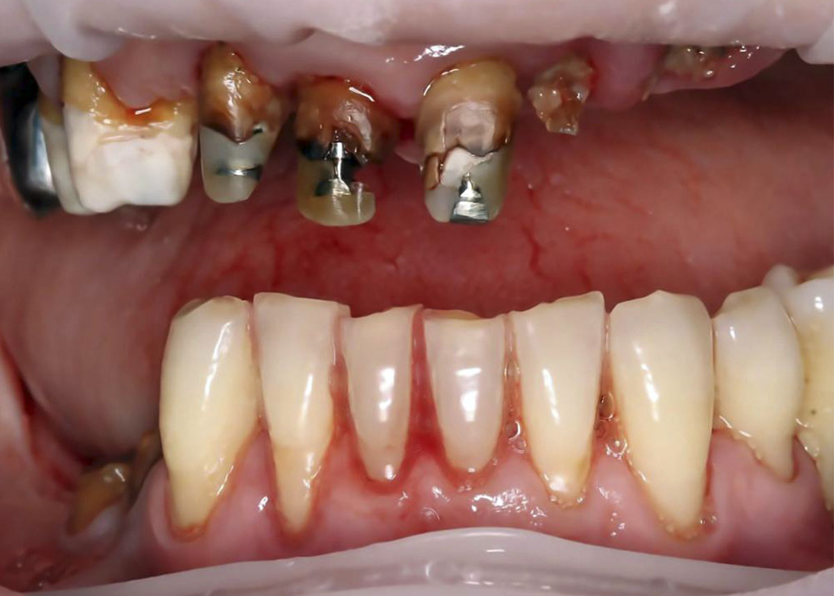 Лечение проблемы множественного отсутствия зубов