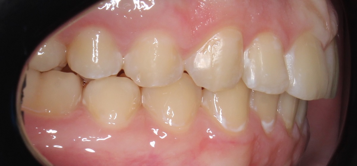 Коррекция бугоркового соотношения