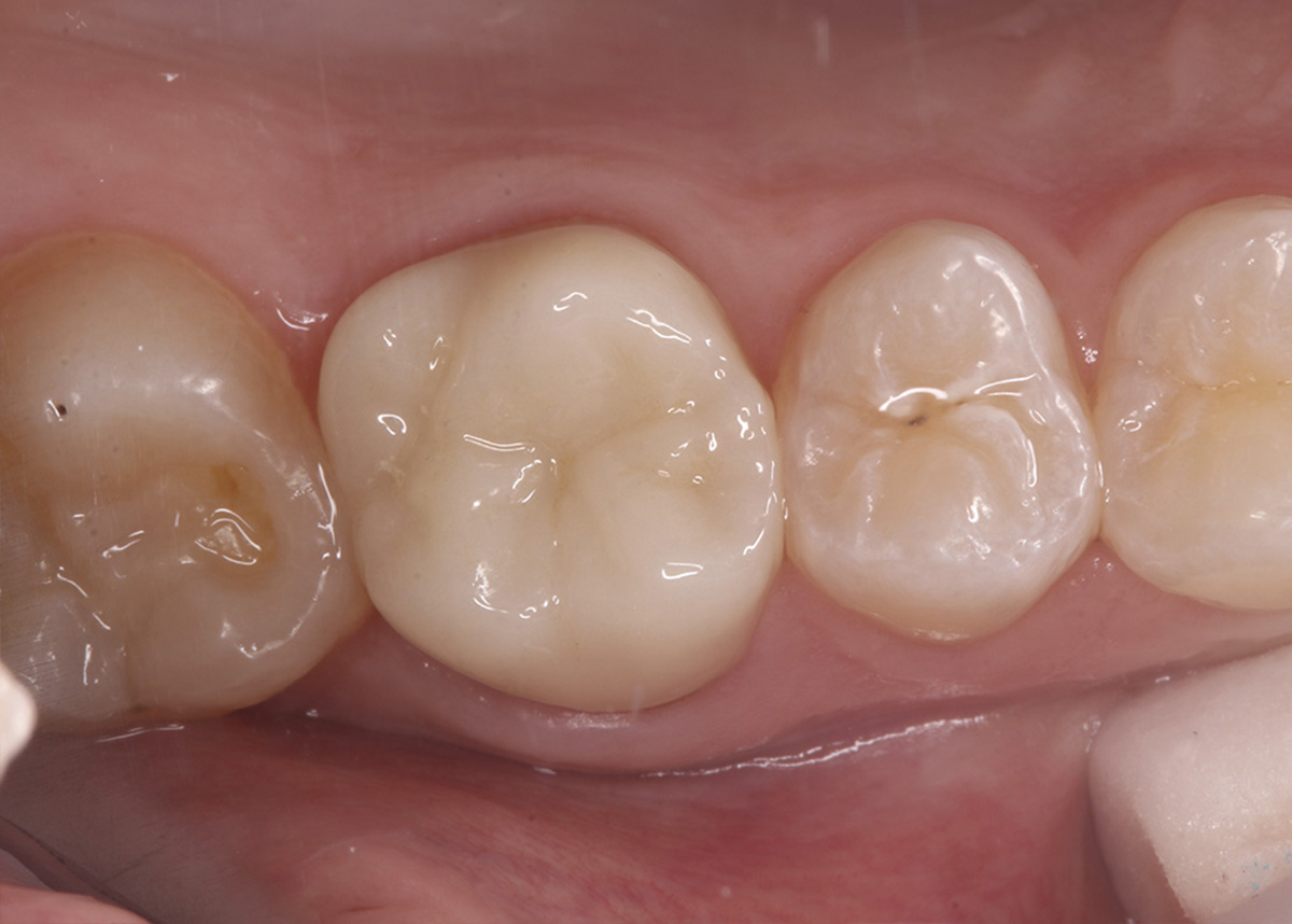 Восстановление разрушенного зуба керамической коронкой
