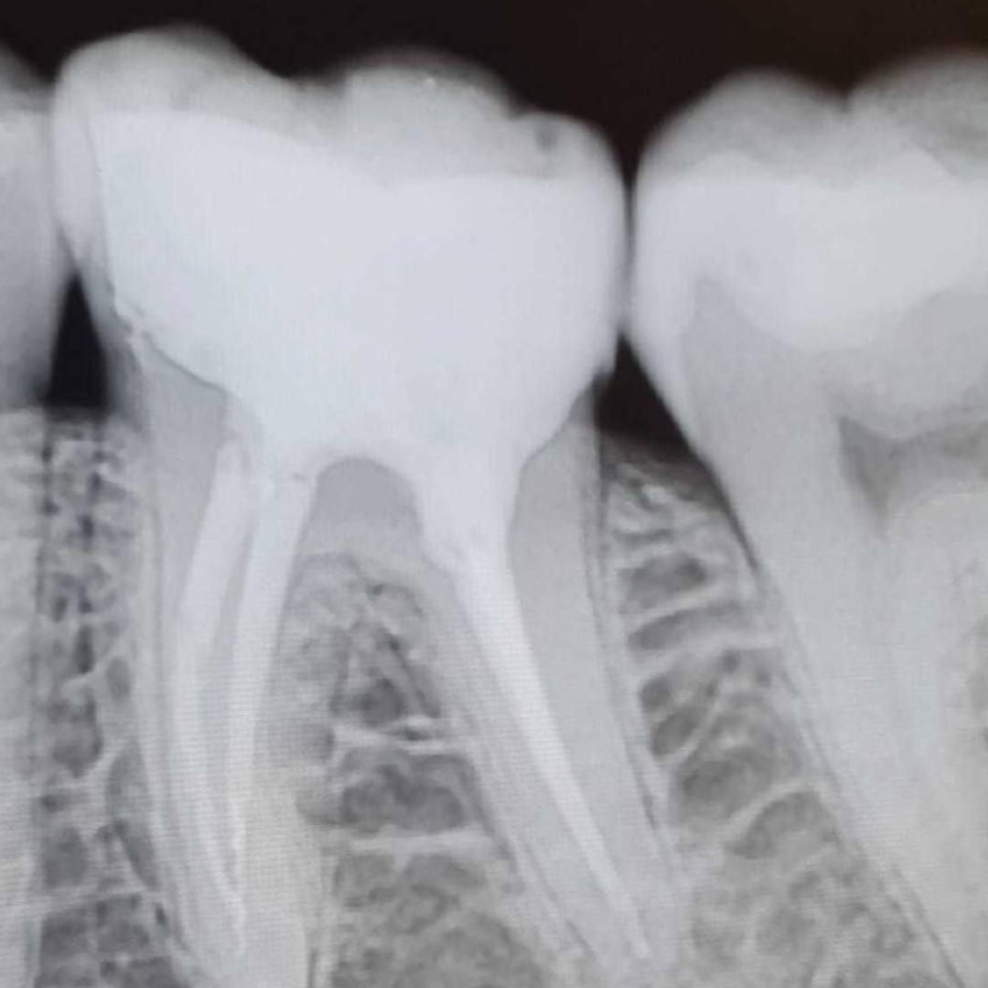 Эндоперелечивание зуба