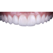 Коронки E-MAX