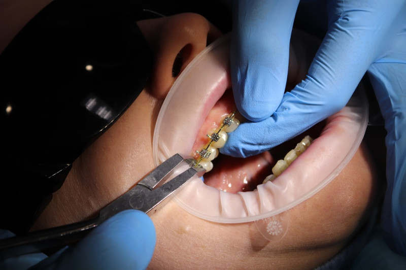 Брекеты для взрослых: какие бывают виды и сколько стоит установка?
