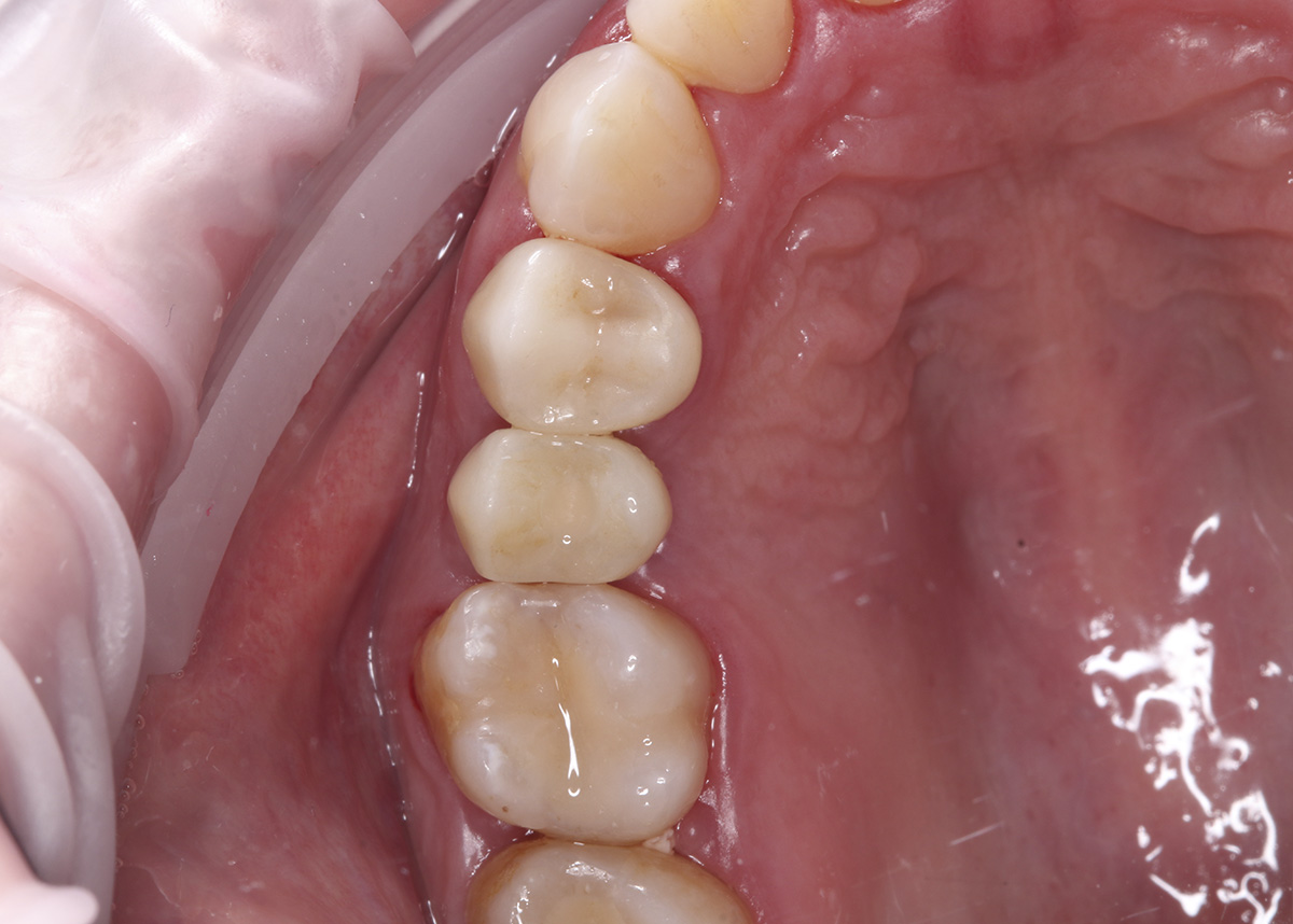 Восстановление зуба коронкой на имплантате