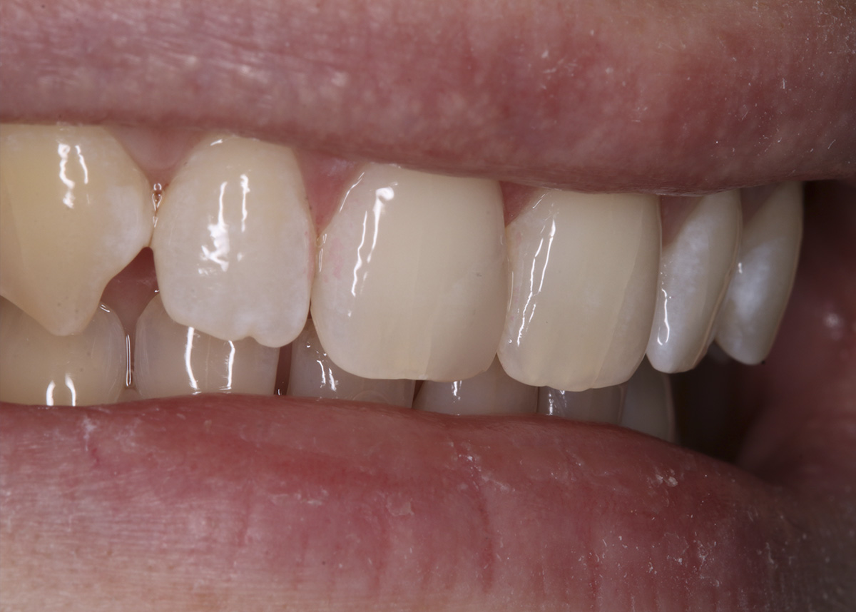 Реставрация центрального зуба пломбой