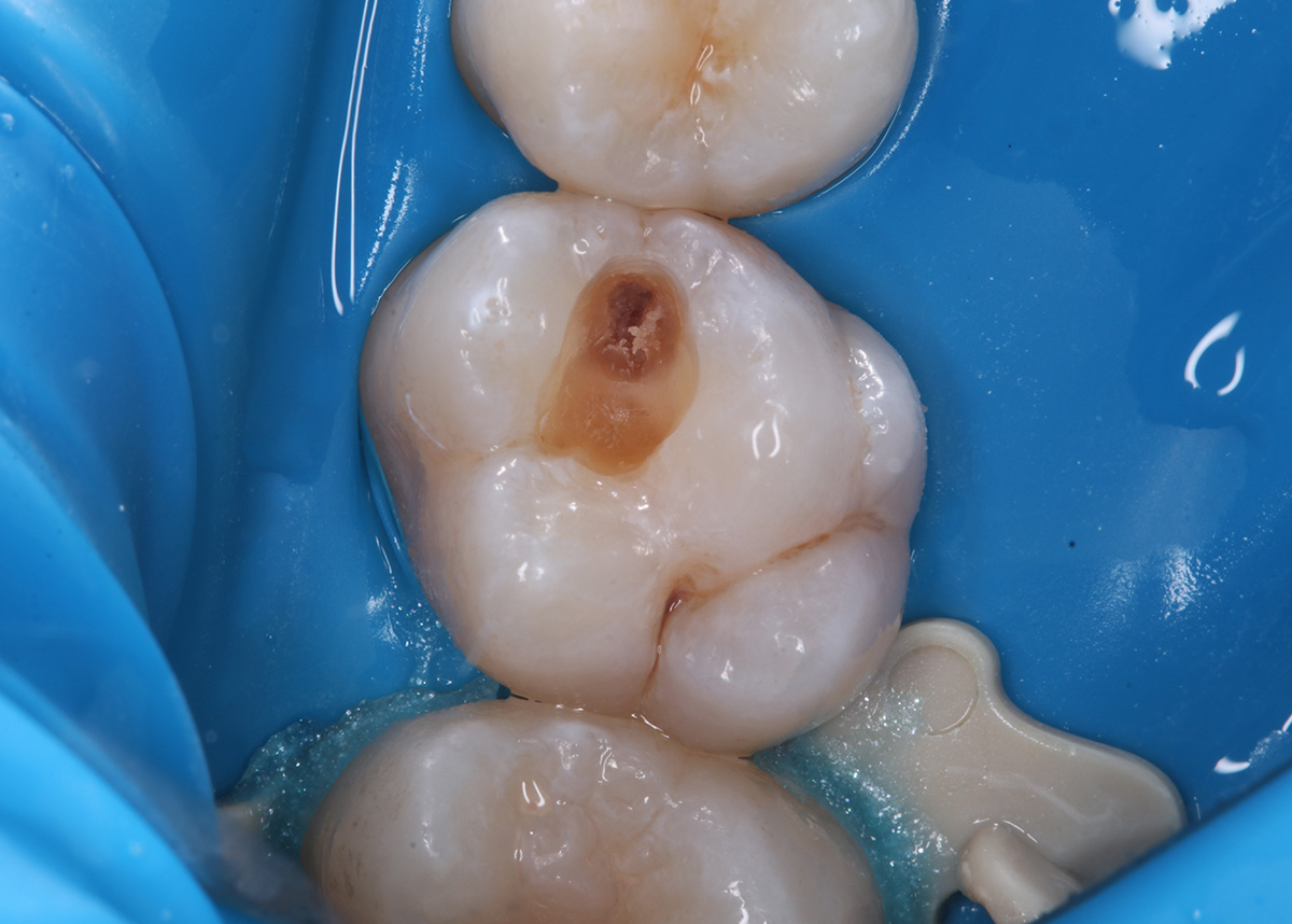 Восстановление зуба - лечение скрытой кариозной полости