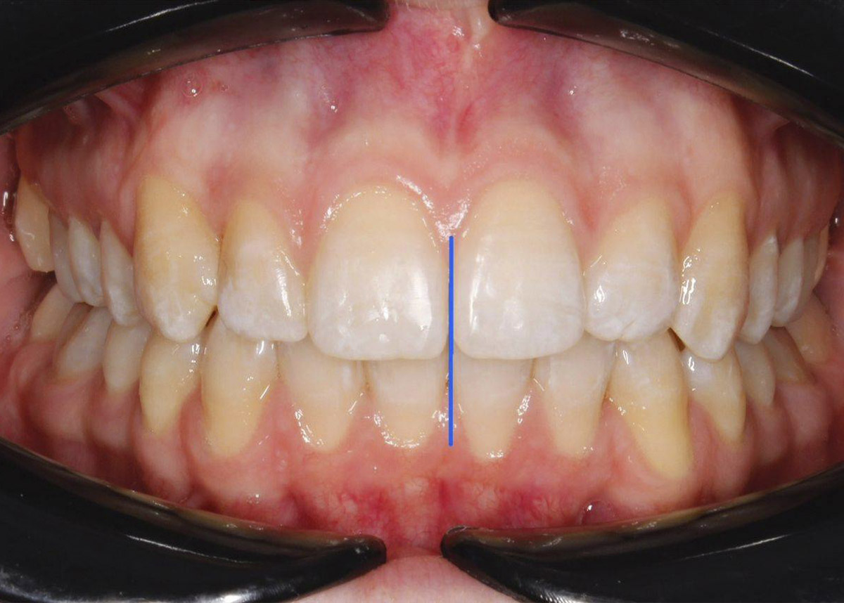 Коррекция центральной линии и устранение скученности зубного ряда