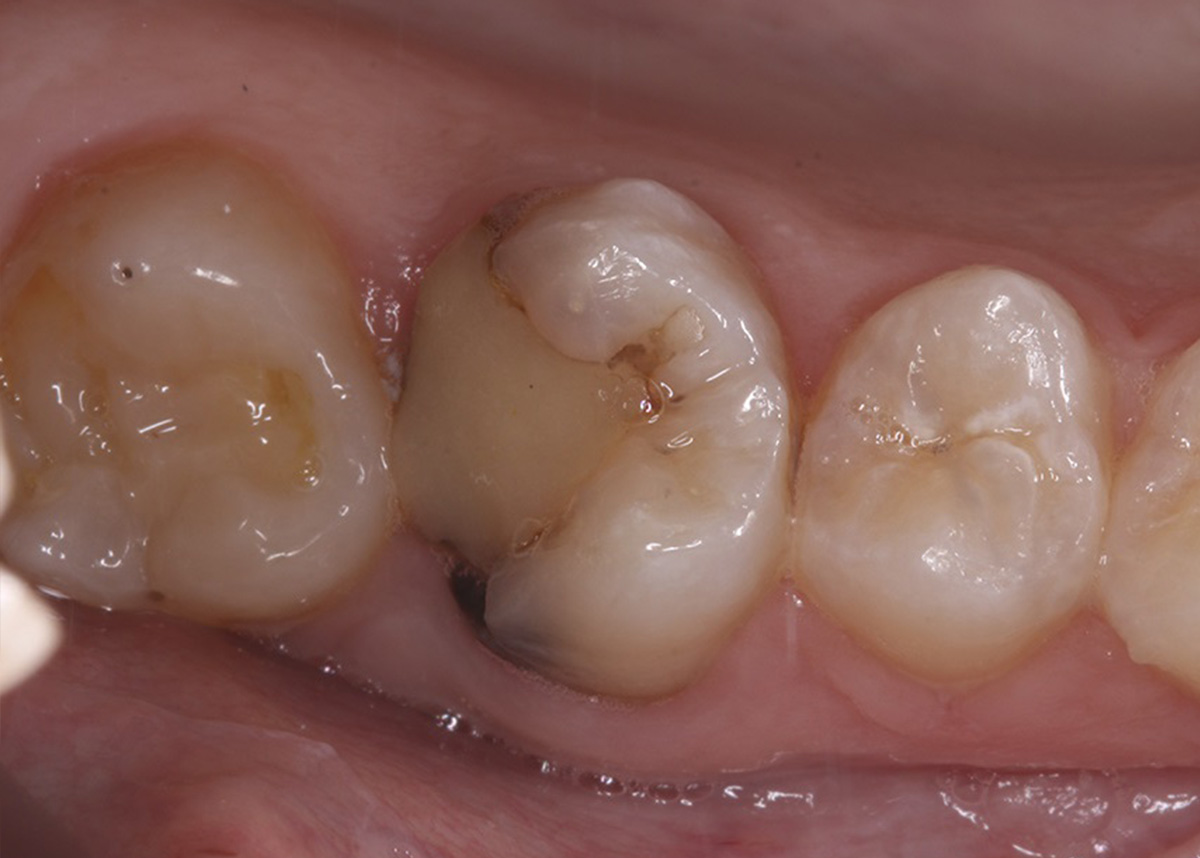 Восстановление разрушенного зуба керамической коронкой