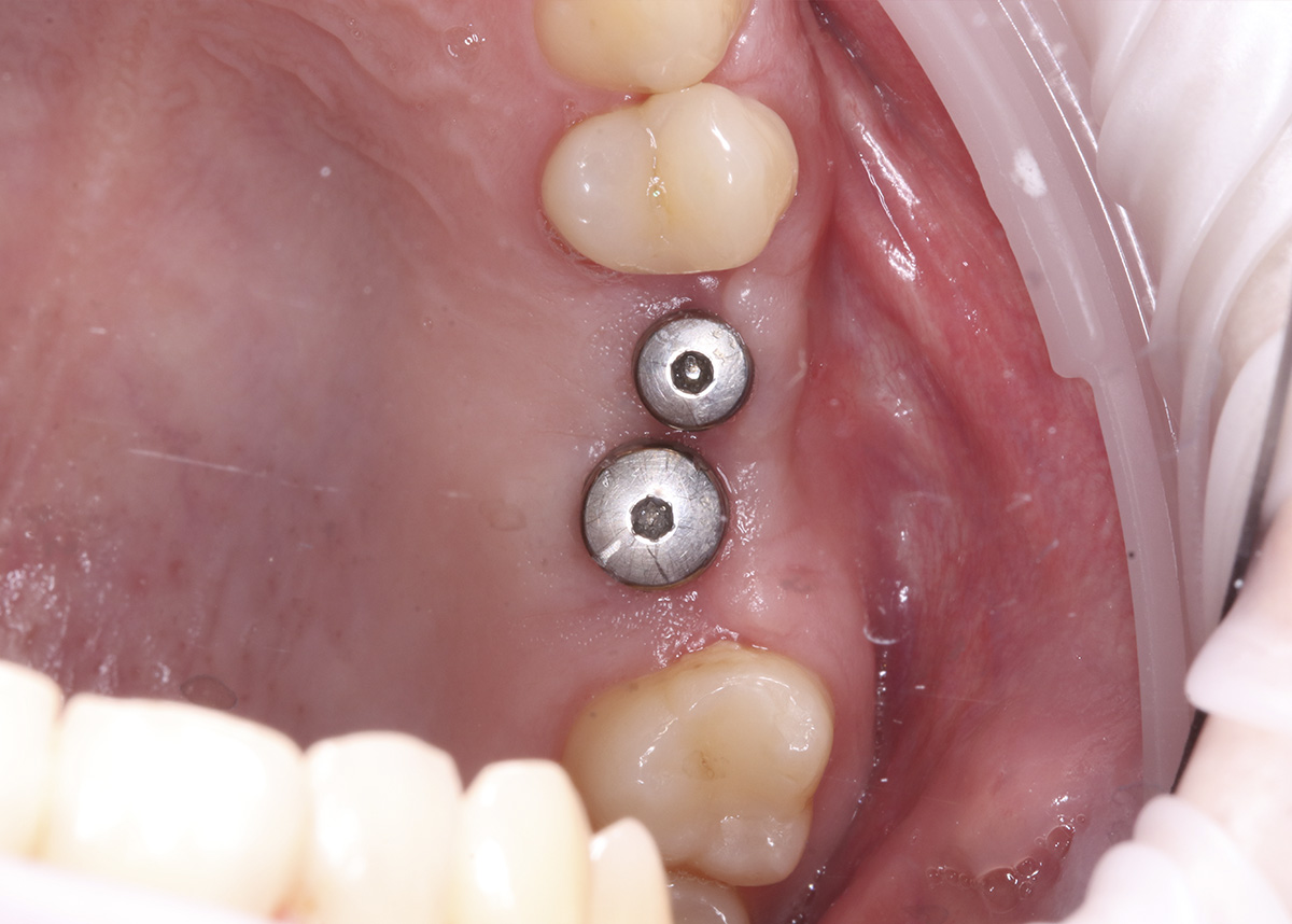 Восстановление целостности зубного ряда при помощи коронок на имплантатах