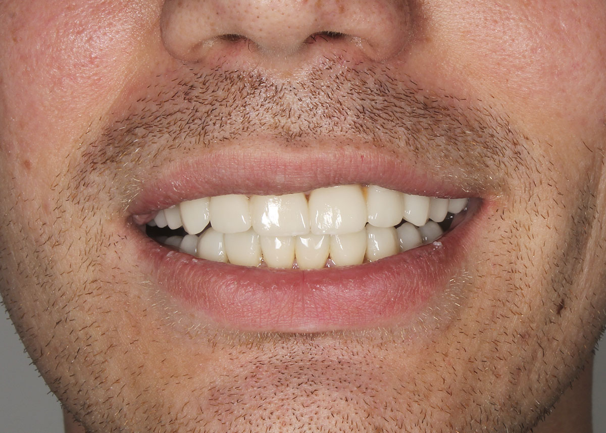 Пациент обратился с жалобами на эстетический вид улыбки, а именно форма и цвет зубов 