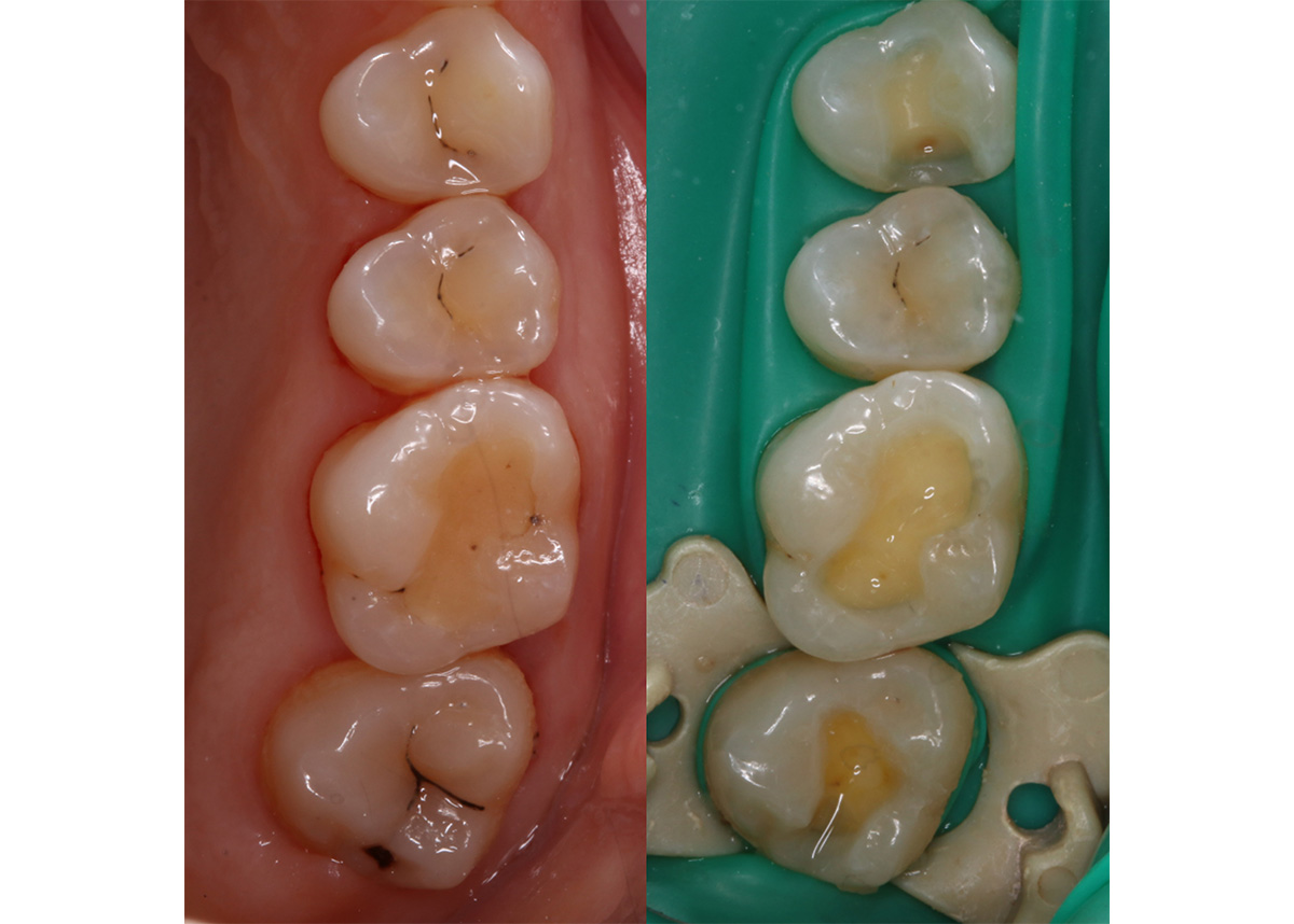 Лечение кариеса зубов и замена старой пломбы