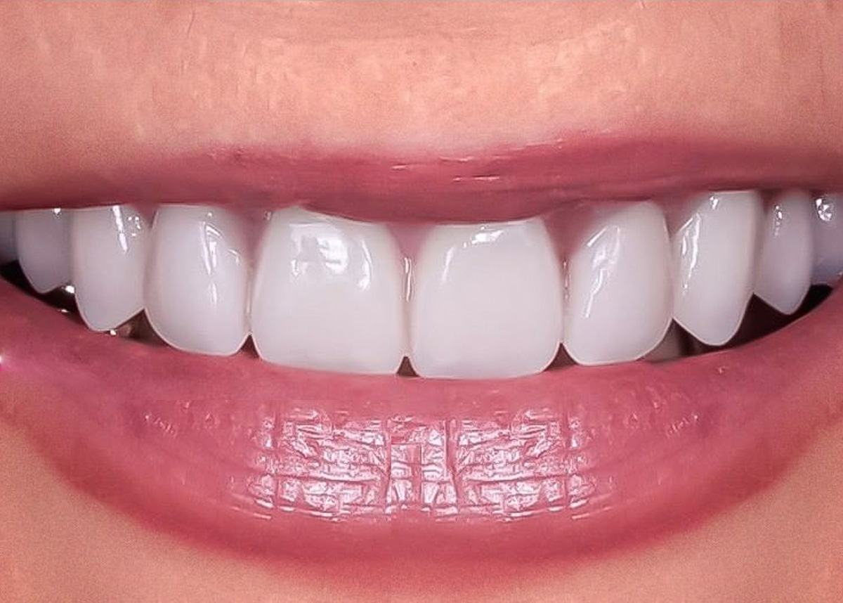 Восстановление жевательной функции с помощью имплантации зубов