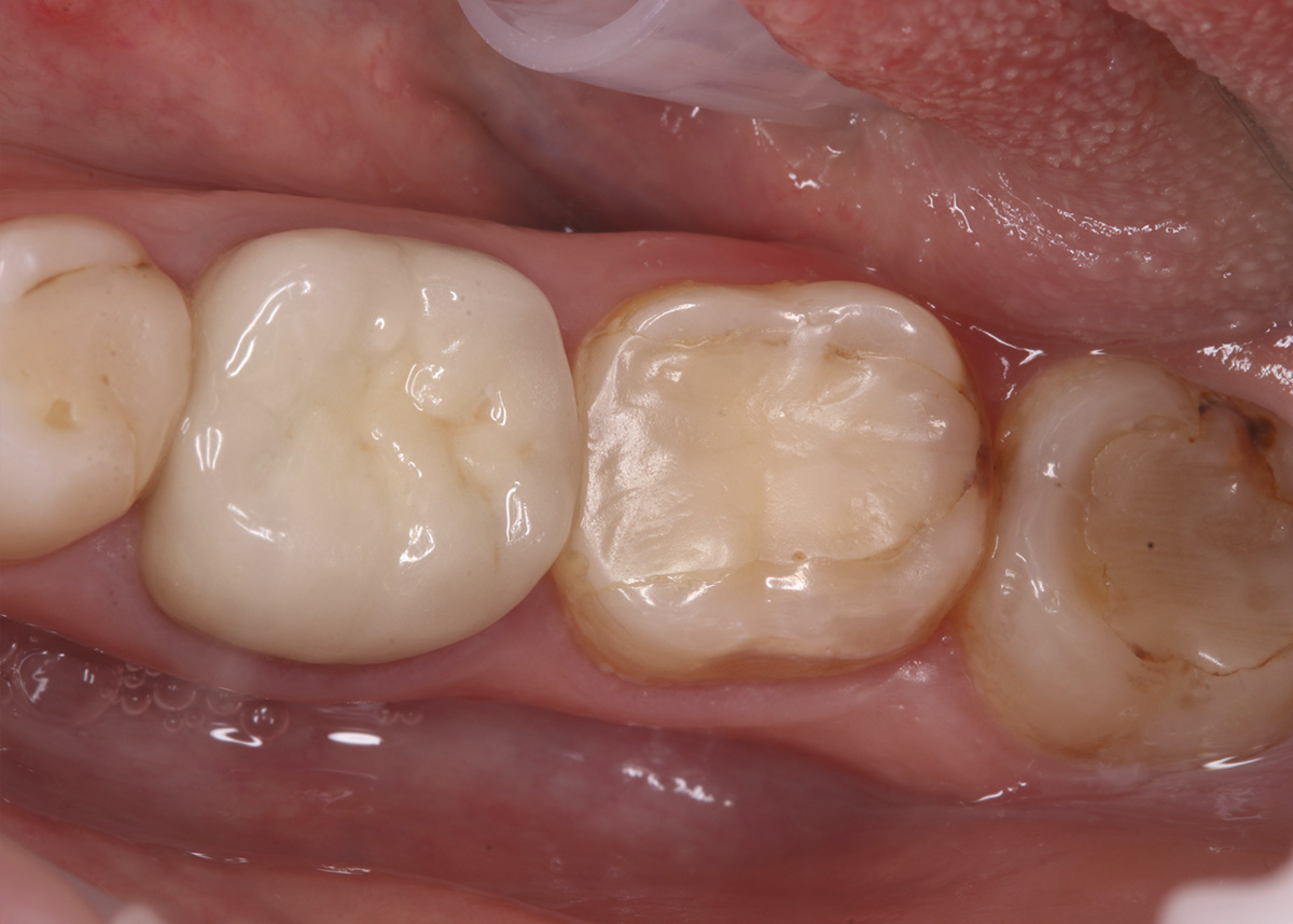 Восстановление разрушенного зуба керамической вкладкой накладкой