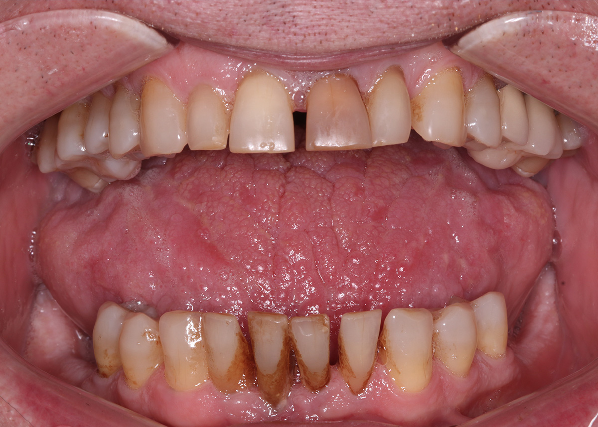 Проведена большая работа по восстановлению целостности зубного ряда на нижней челюсти