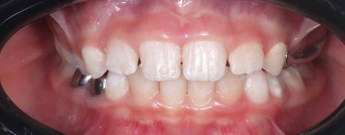 Коррекция прикуса на детских элайнерах