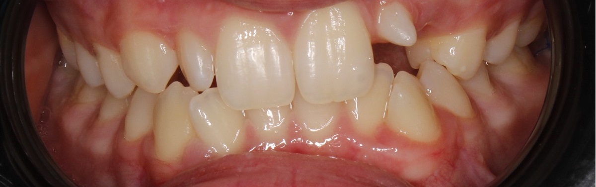 Коррекция смыкания, коррекция канта и реставрации боковых зубов после ортодонтического лечения.