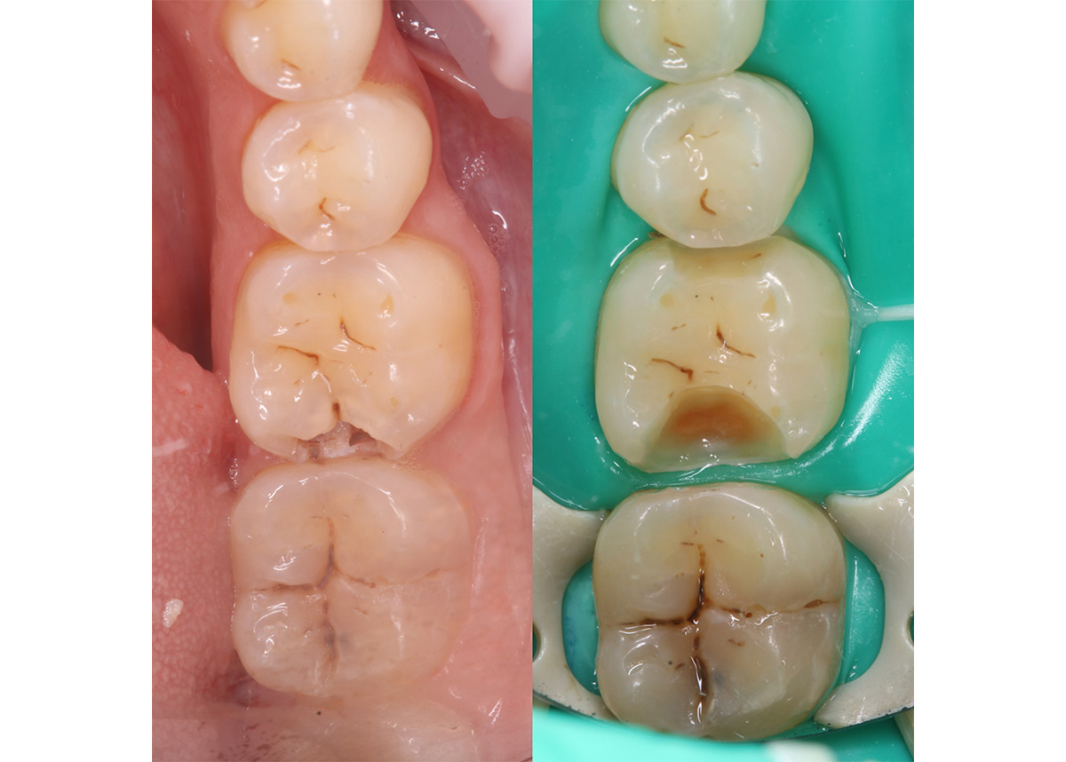 Восстановление зуба пациента пломбой 