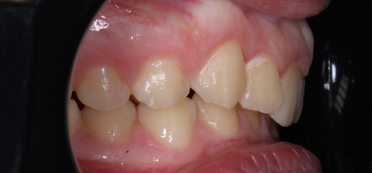 Коррекция бугоркового соотношения