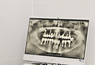 Что входит в имплантацию зубов 