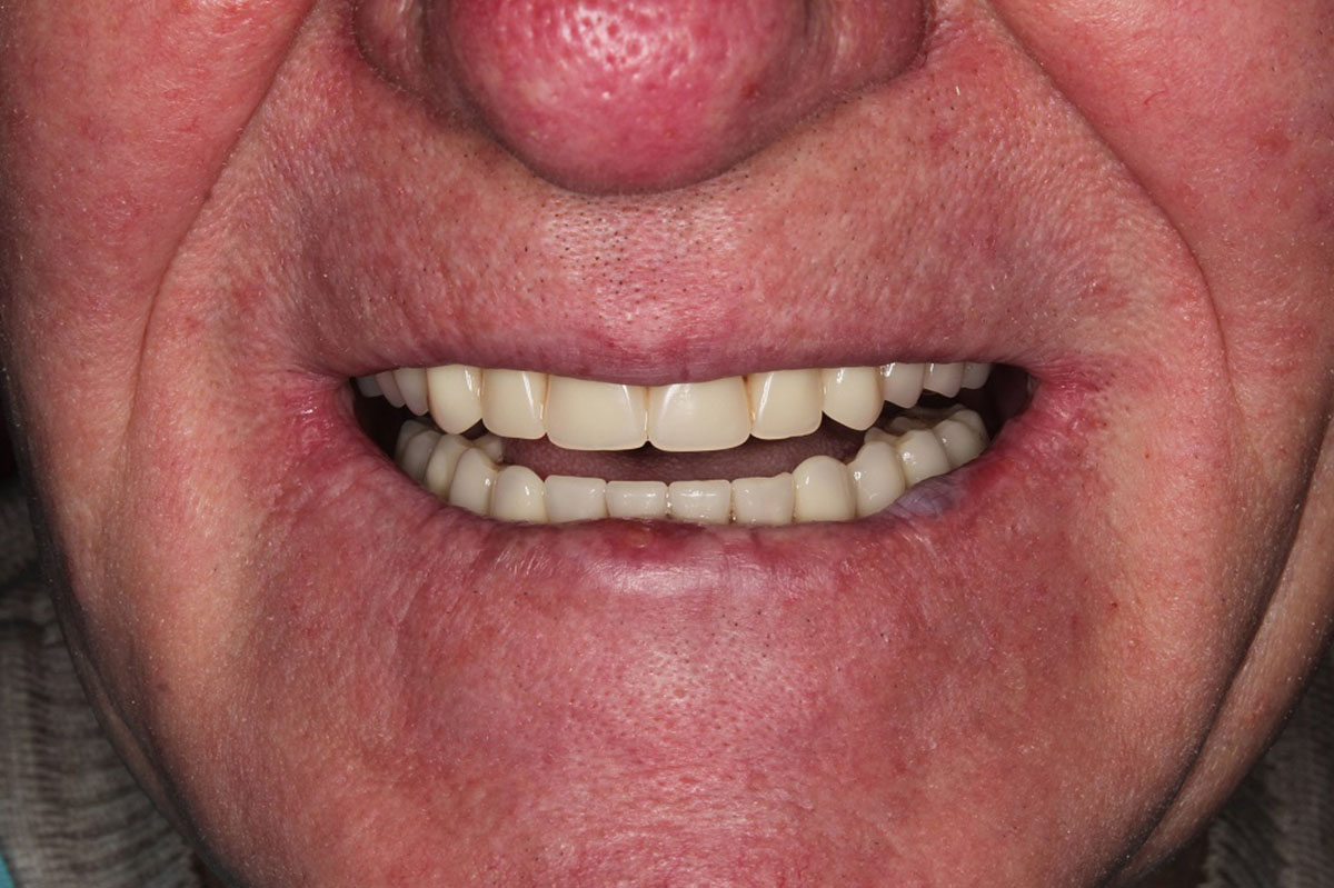 Пациент обратился в клинику с целью восстановления отсутствующих зубов и жевательной функции