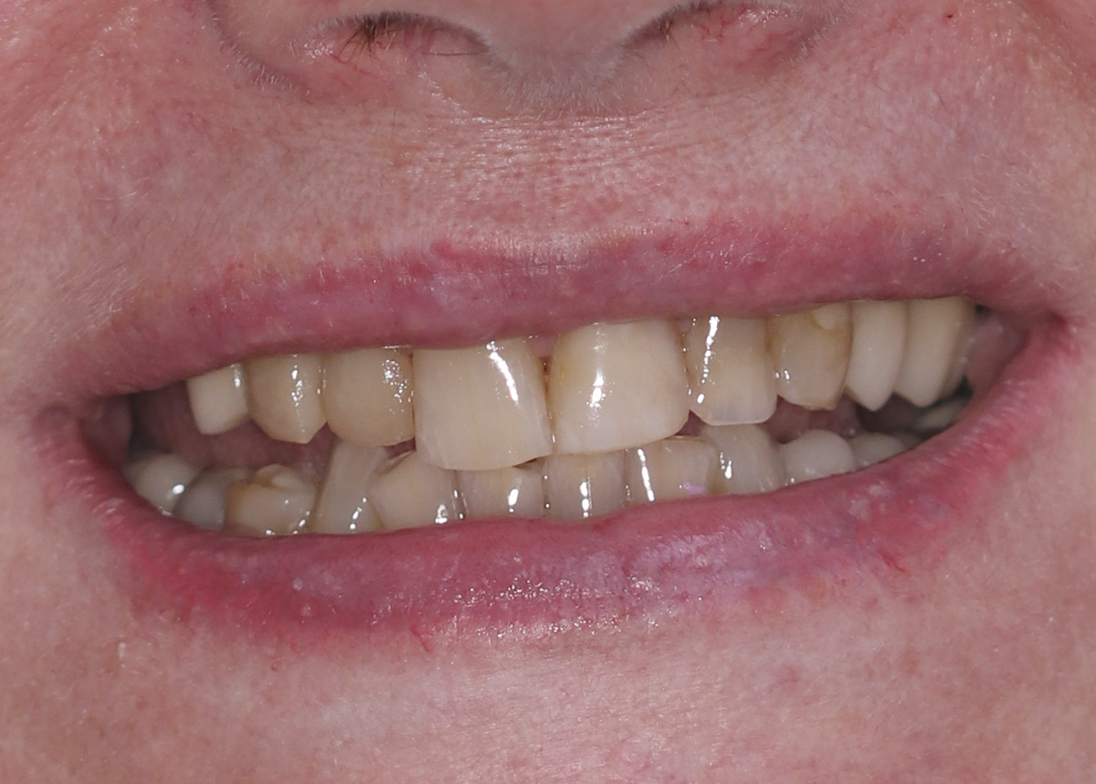Протезирование зубов керамическими коронками EMAX