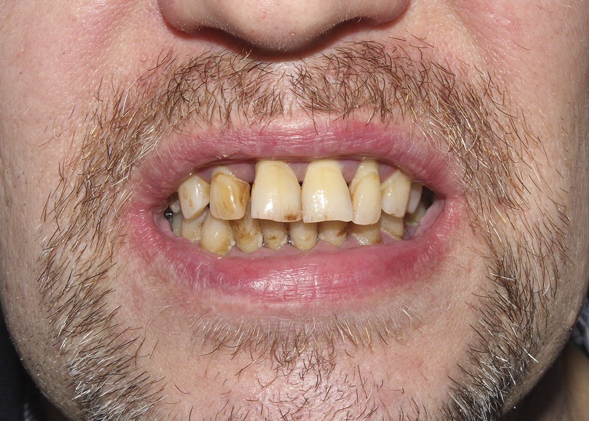 Пациент обратился с жалобами на подвижность всех зубов и генерализованный пародонтит