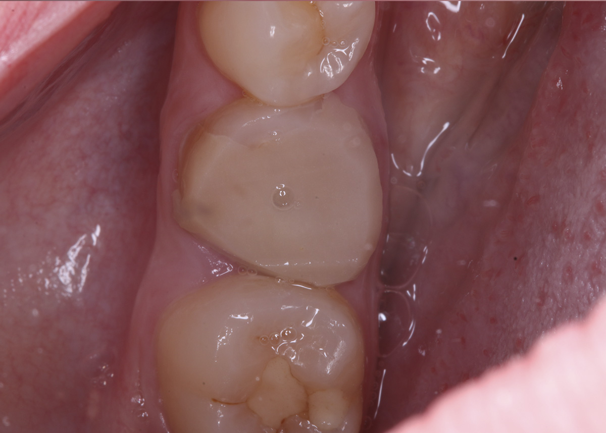 Восстановление зуба диоксидциркониевой коронкой