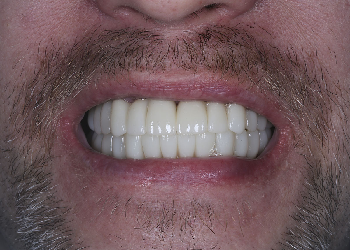 Пациент обратился с жалобами на подвижность всех зубов и генерализованный пародонтит