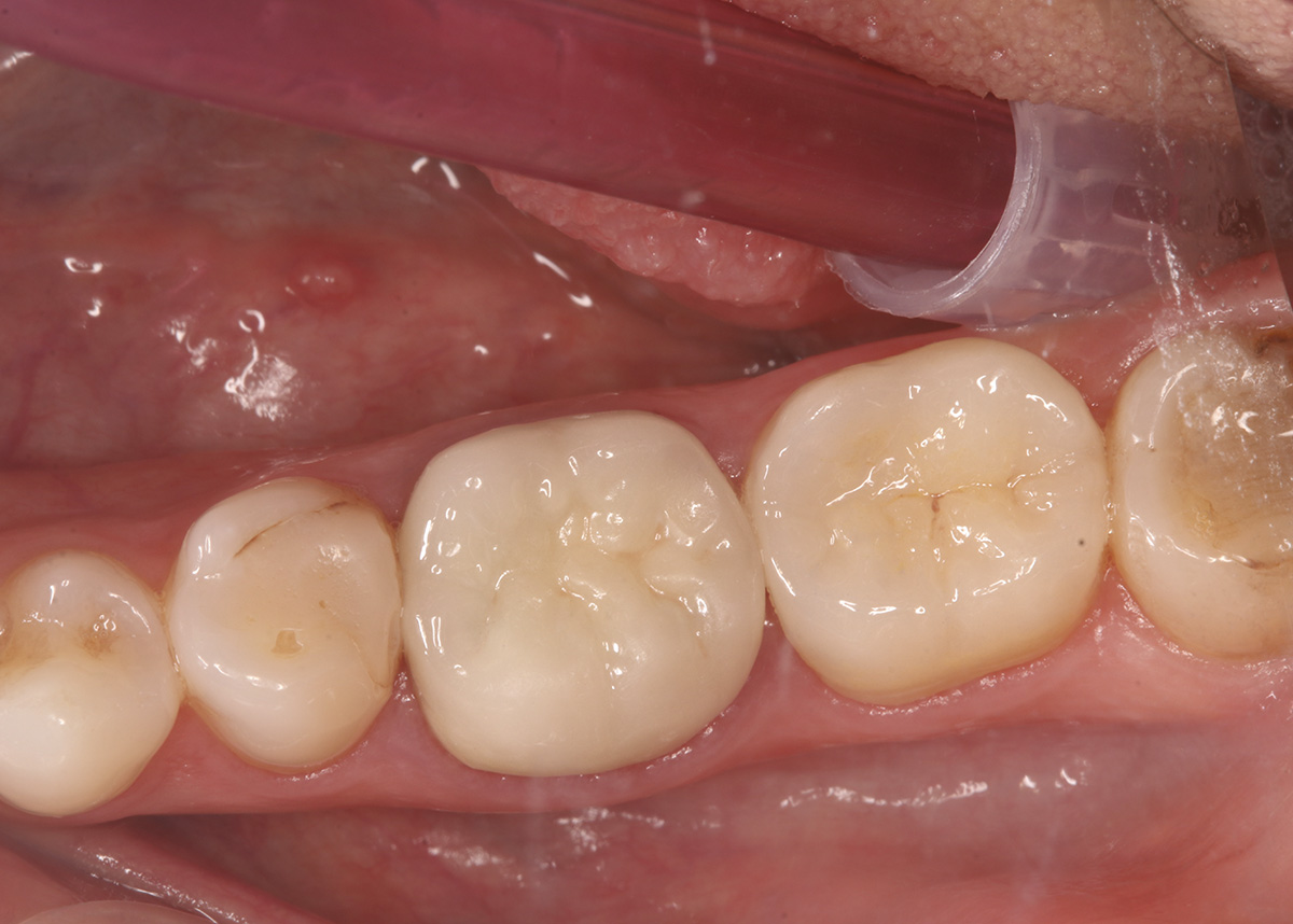 Восстановление разрушенного зуба керамической вкладкой накладкой