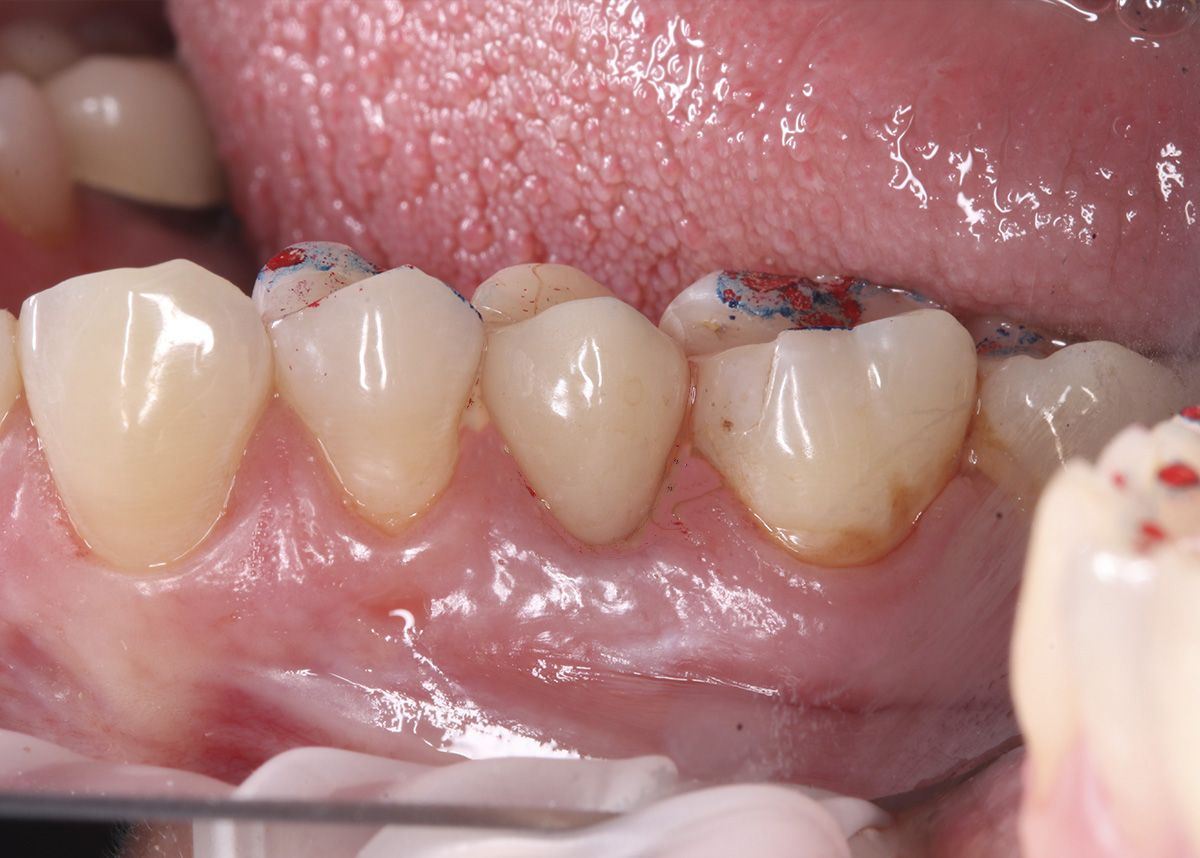 Пациентка обратилась в клинику с жалобой на скол зуба. зуб был восстановлен керамической коронкой