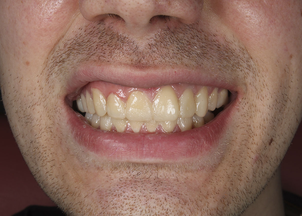 Пациент обратился с жалобами на эстетический вид улыбки, а именно форма и цвет зубов 