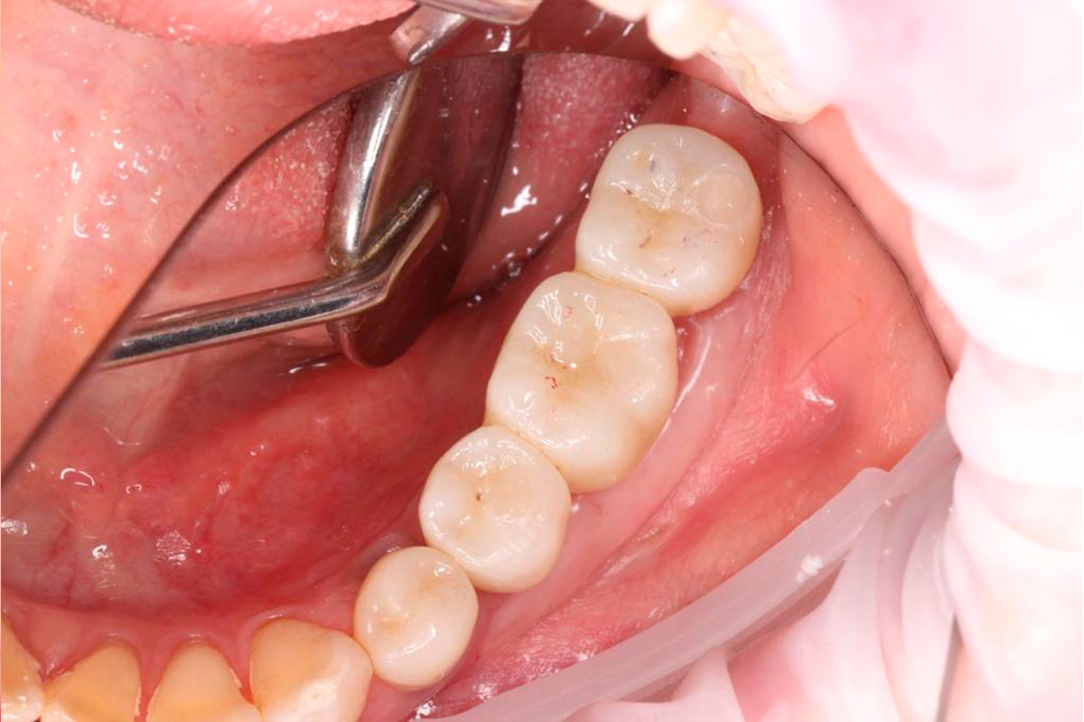 Удаление зубов с последующей костной пластикой
