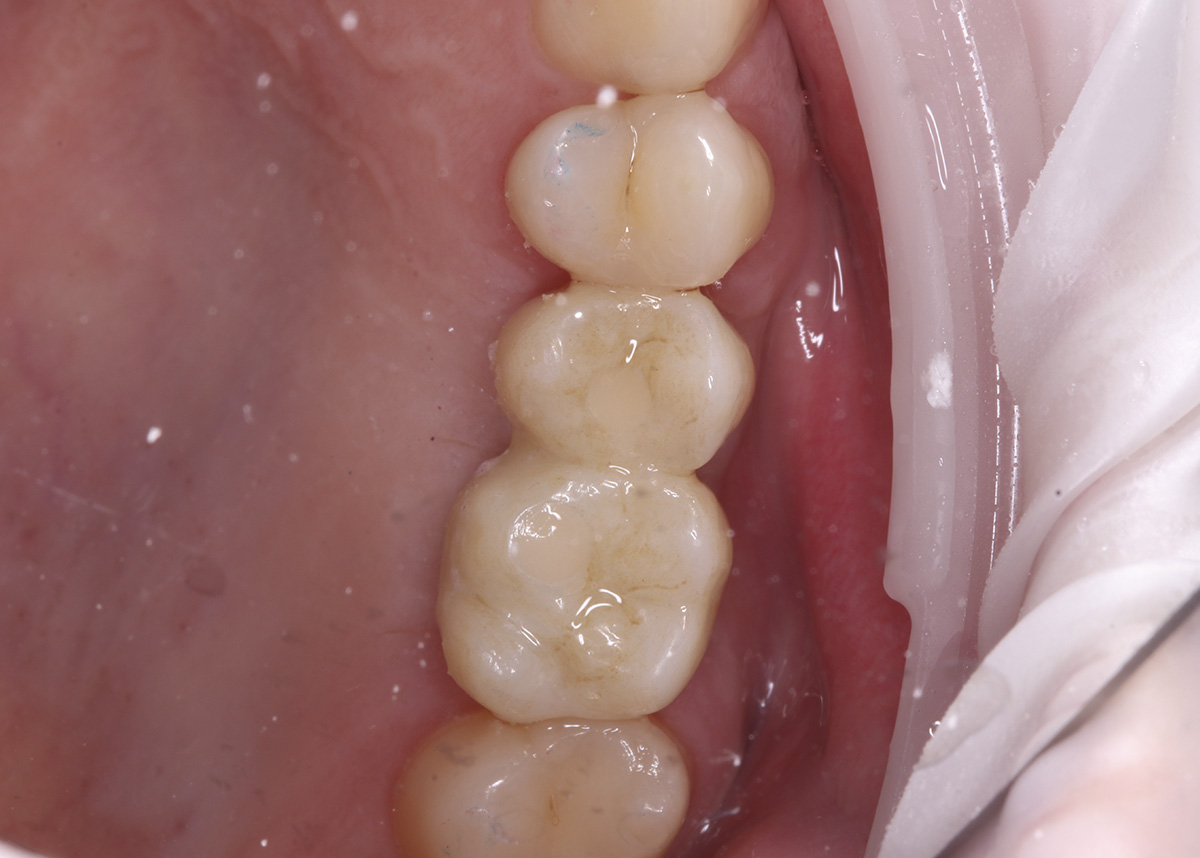 Восстановление целостности зубного ряда при помощи коронок на имплантатах