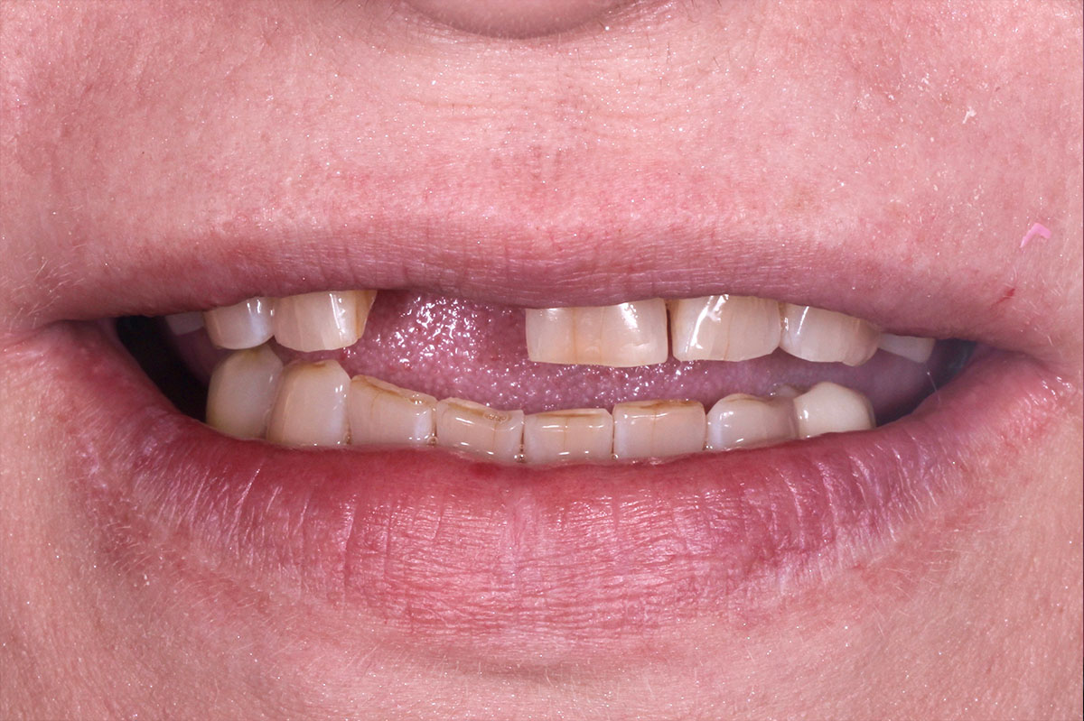 Тотальное протезирование зубов керамическими винирами и коронками E.max