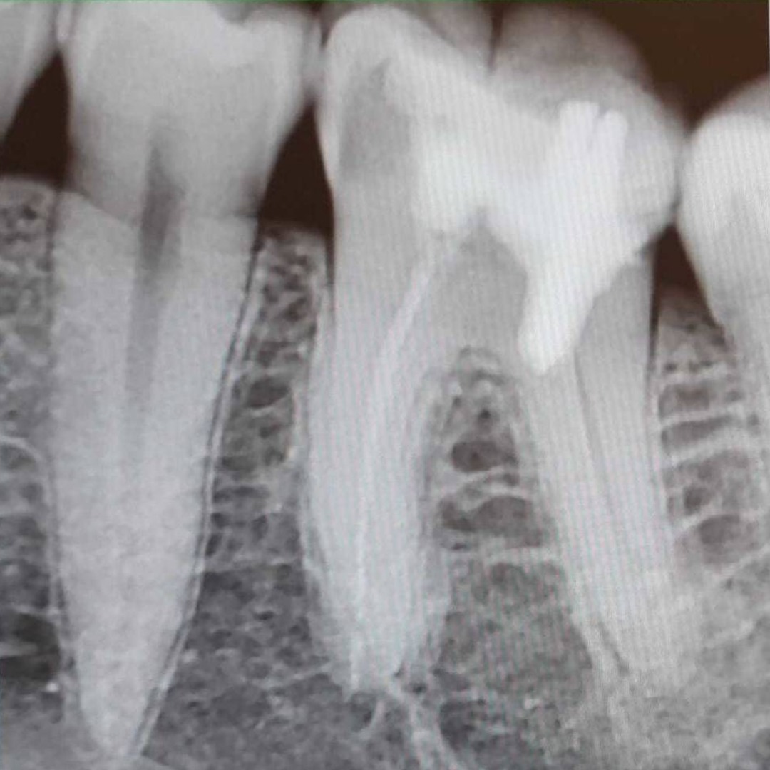 Эндоперелечивание зуба